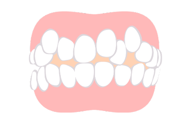 八重歯・乱ぐい歯（叢生）