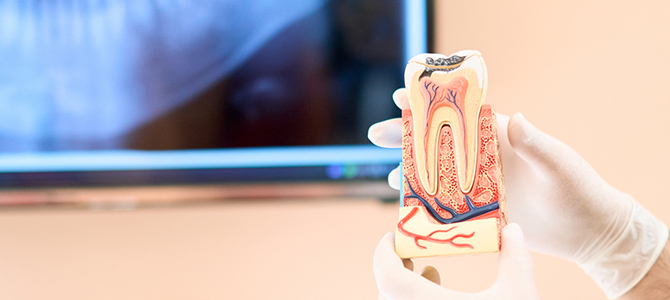 米国式根管治療